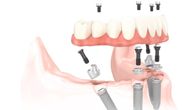  <i>Complete</i> oral restoration