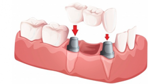 implantes dentales marbella