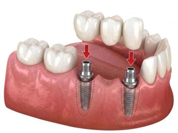 Implantes dentales Straumann Marbella