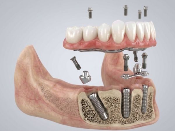 Rehabilitación oral completa