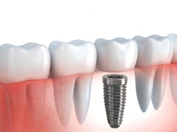 Implante dental unitario