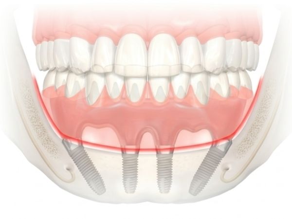 Implantes Carga Inmediata
